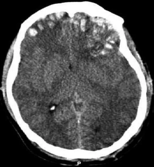 Medical illustration depicting brain structures affected by traumatic brain injury